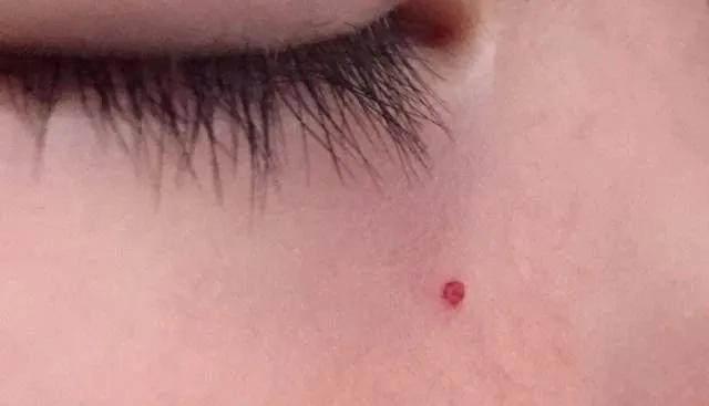 后背疼前胸红痣有点疼_前胸后背疼有红痣_后背疼前胸红痣有点痒