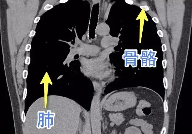 肺白ct图片_肺白吃什么水果好_肺ct 白