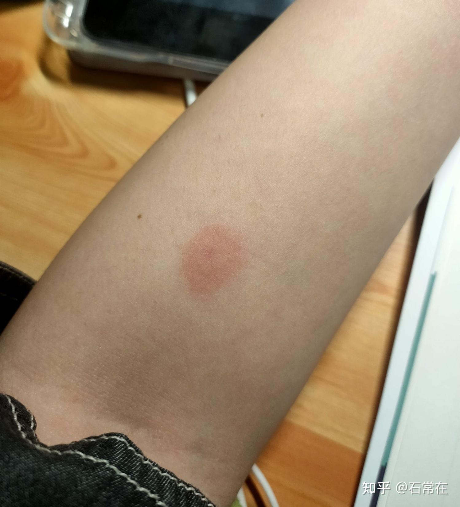 肺传染结核型会传染人吗_肺结核传染就会发病吗_三型肺结核会传染吗
