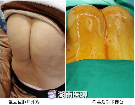 前胸后背肿痛_前胸后背疼 背部还有个肿块_背部后背疼前胸肿块怎么回事