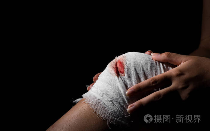 肛瘘手术里的纱布多长时间脱落_肛瘘手术取纱布_肛瘘纱布掉了