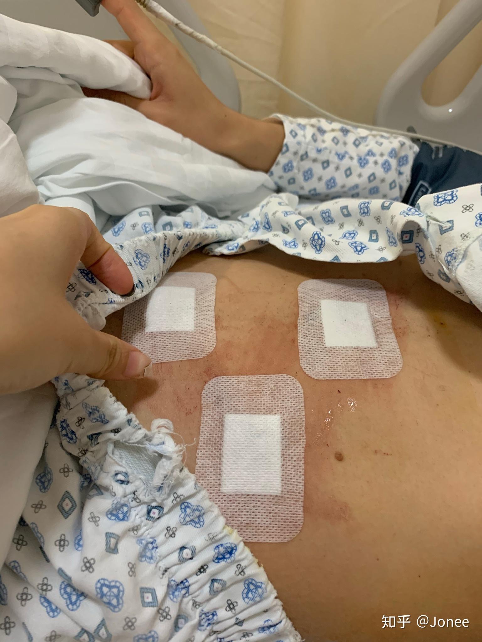 急性阑尾炎术后的护理要点_急性阑尾炎的术后护理_急性炎护理术阑尾后多久恢复