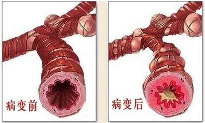 支气管肺炎小儿治疗_气管肺炎支治疗儿童首选药物_儿童支气管肺炎如何治疗