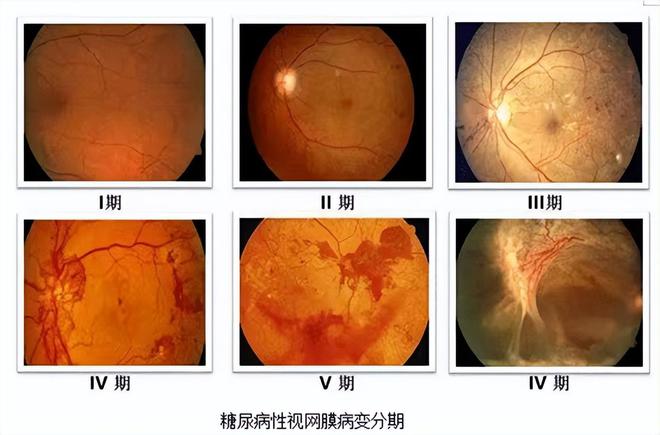 肺结核自愈还需要治疗吗_三型肺结核可以自愈吗_肺结核自愈期间会传染吗