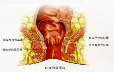 肛瘘手术间隔多久再做_做肛瘘手术多长时间能同房_做肛瘘多久可以同房