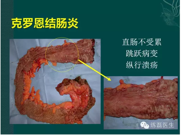 课罗恩病_罗克罗恩病的特征性体征_克罗恩病x线表现