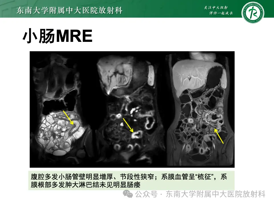 克罗恩病食谱大全_scd饮食克罗恩_克罗恩病饮食