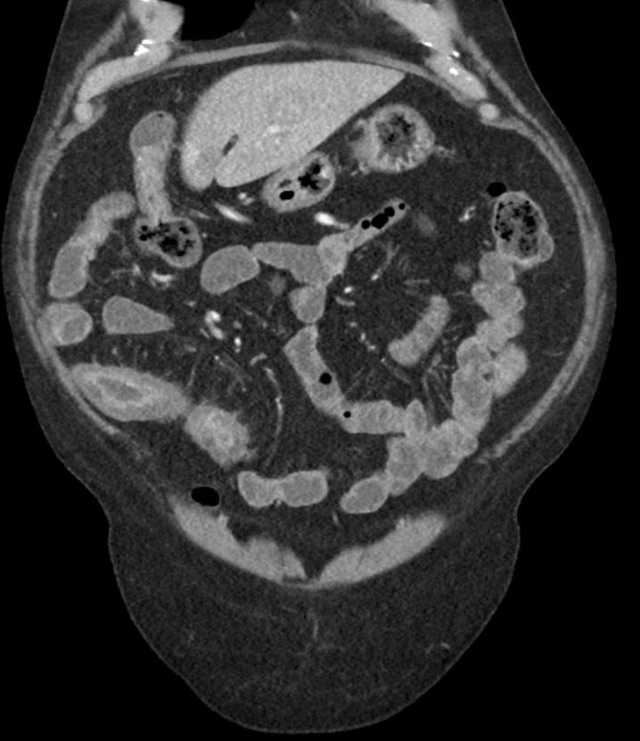 克罗恩病食谱大全_scd饮食克罗恩_克罗恩病饮食