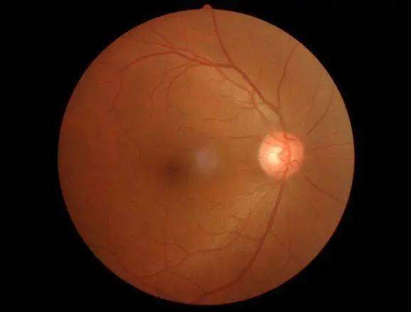 婴儿白眼球发蓝怎么回事_小婴儿白眼球发蓝_婴儿白眼珠子发蓝