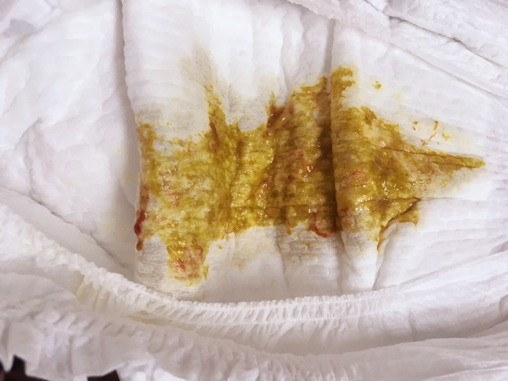鲜血大便_大便出鲜血问题大不大_大便出鲜血是怎么回事