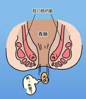 大便失禁肛门袋_大便失禁肛门疼_男友插肛门 大便失禁