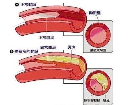 冠心病危险因素是_危险冠心病因素不包括_冠心病危险因素
