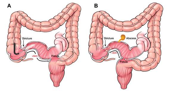 克罗恩病护理措施_克罗恩病的护理诊断_护理措施字母表示
