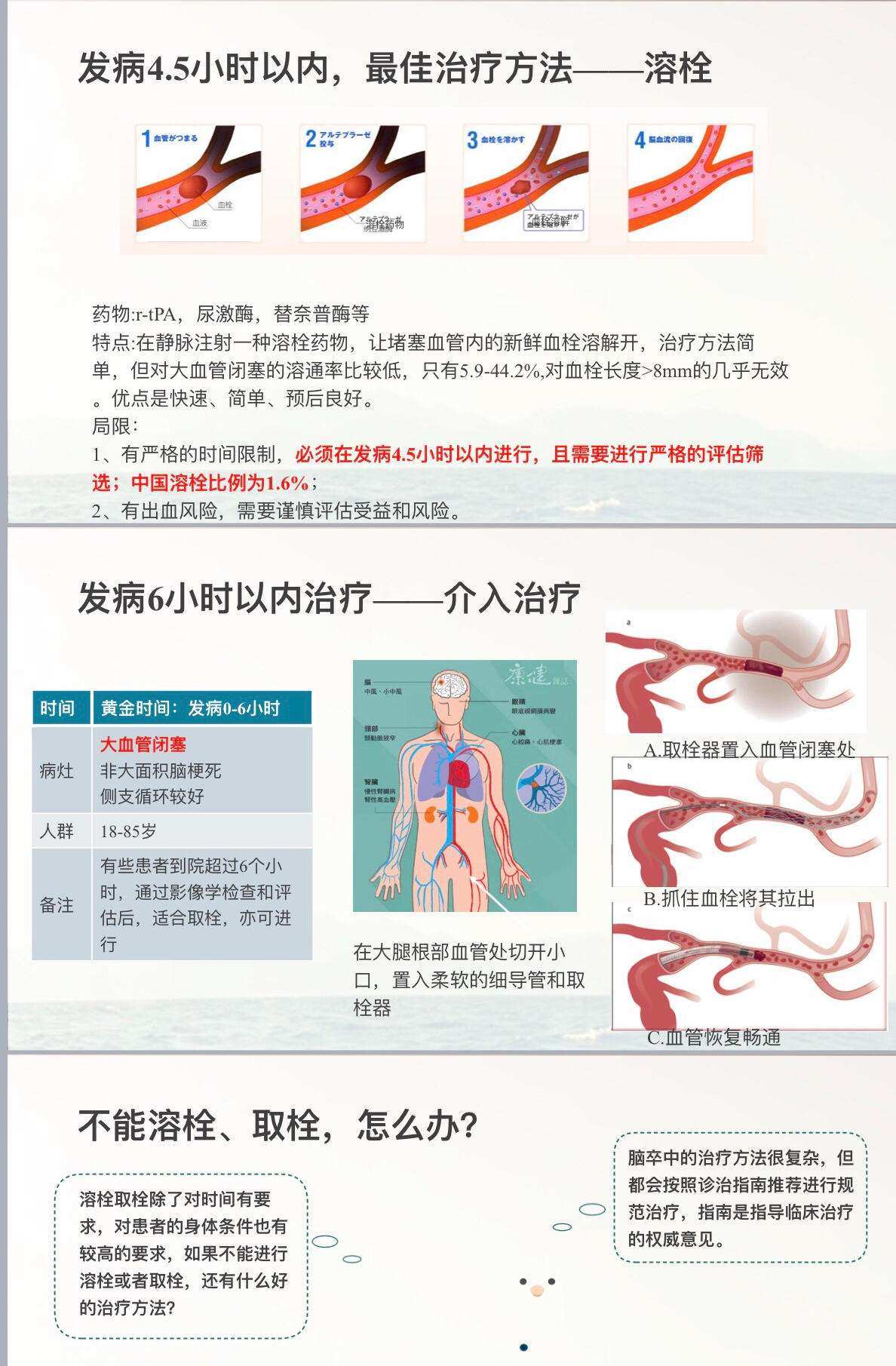 完全性卒中进展性卒中_进展性卒中_进展性卒中的危险因素有哪些