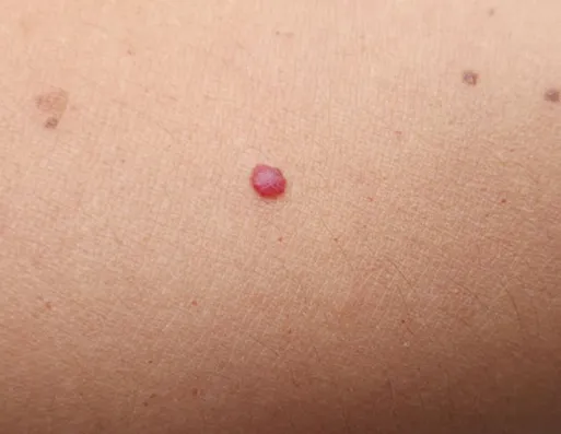 后背疼前胸红痣有点疼_前胸后背疼有红痣_后背疼前胸红痣有点痒