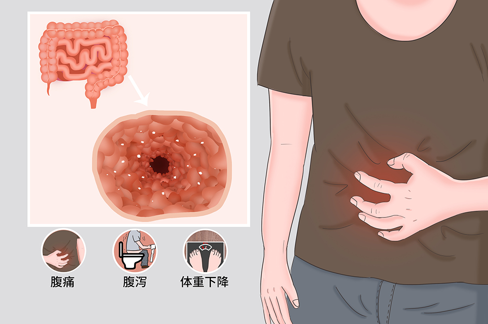 克罗恩病食谱app_克罗恩病食谱_罗克罗恩病