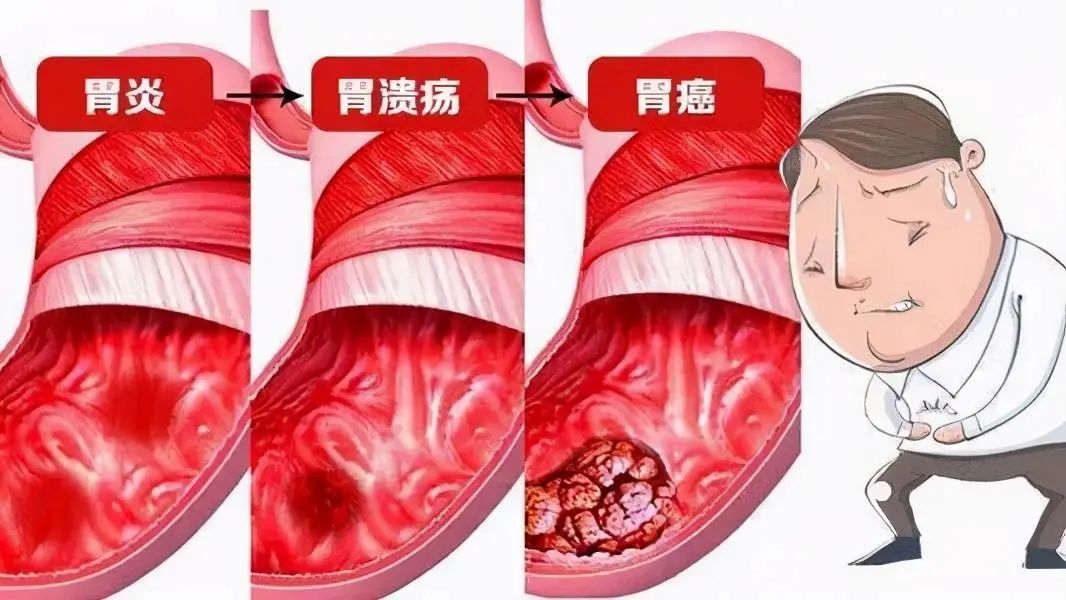 胃中医治疗溃疡的方子_中医治疗胃溃疡_中医治疗胃溃疡的效果