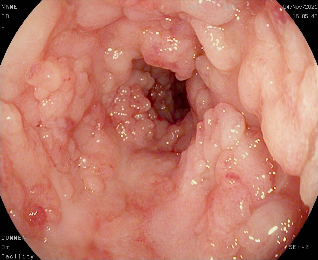 护理措施字母表示_克罗恩病的护理诊断_克罗恩病护理措施