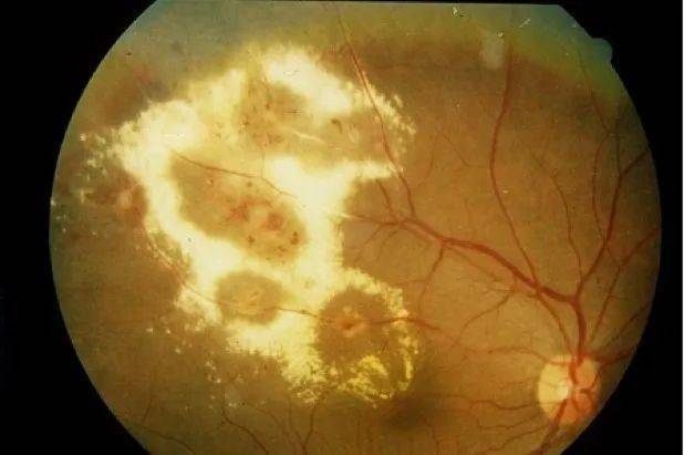 婴儿白眼球发蓝怎么回事_婴儿白眼珠子发蓝_小婴儿白眼球发蓝