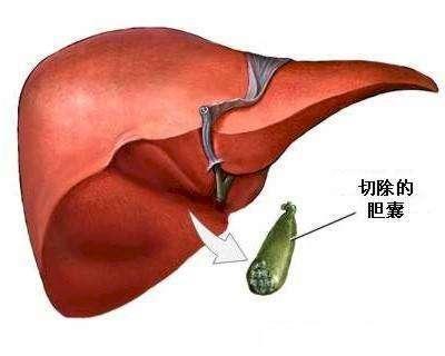 急性阑尾炎术后5个护理问题_急性阑尾炎手术后的护理_急性阑尾炎术后护理要点是什么