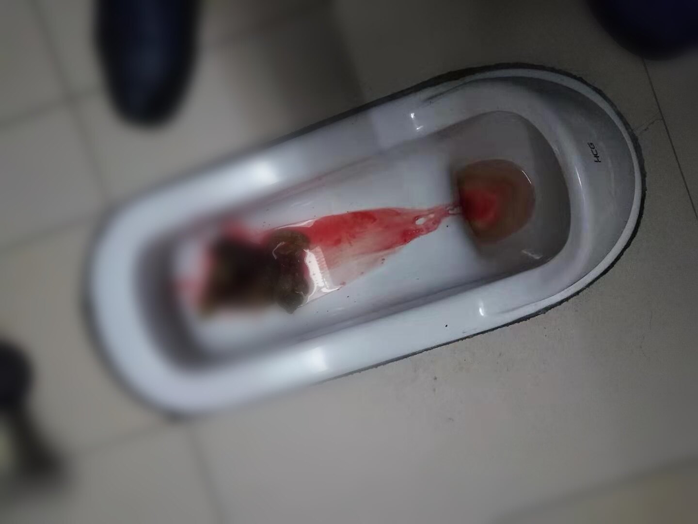 大便出血结肠炎_溃疡性结肠炎大便拉出很多鲜血_鲜血大便结拉肠炎性出血怎么办