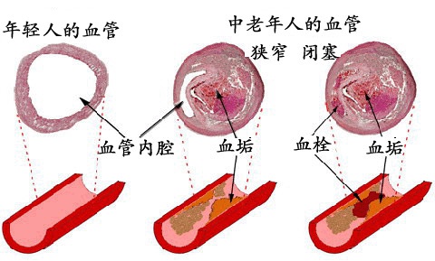 脑血管栓塞 脑血管栓塞