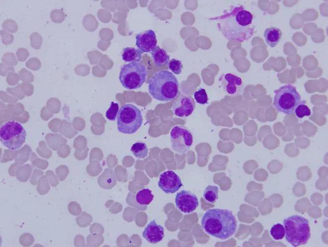 crohn病_crohn病是什么医学意思_crohn