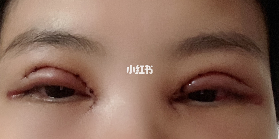 双眼皮拆线好天天洗脸吗_双眼皮几天拆线最好_双眼皮拆线好天天换药吗