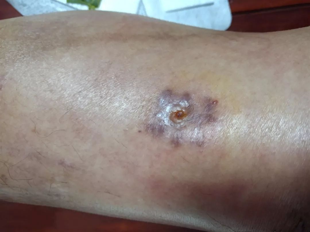 肛瘘术后坐浴疼痛感强_手术坐浴肛瘘时间后多久恢复_肛瘘手术后坐浴时间