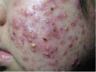 青春痘好治疗_青春痘治愈_青春痘为什么久治不愈