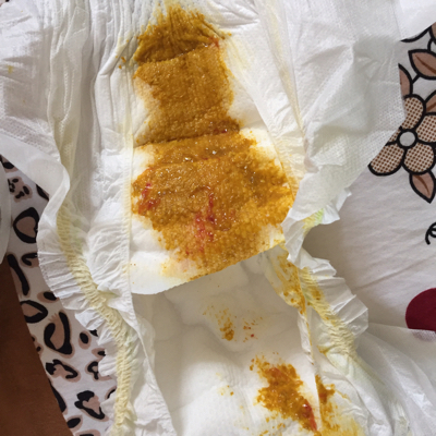 大便出鲜血是怎么回事_大便出鲜血问题大不大_鲜血大便