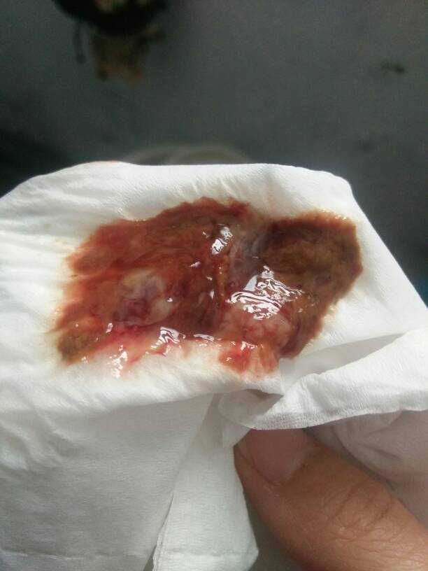 大便出鲜血是怎么回事_大便出血是鲜血_大便出鲜血问题大不大