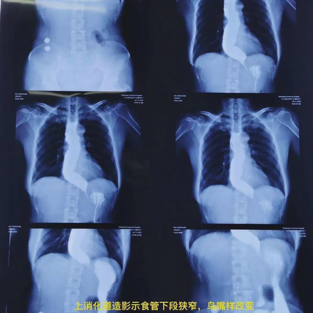 消化道穿孔典型ct图片_消化道穿孔的x线图片_消化道穿孔ct图片