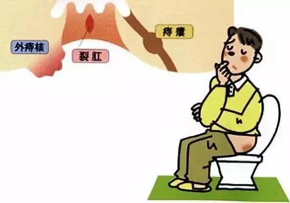 肛门症状排便失禁怎么回事_肛门症状排便失禁怎么办_肛门失禁的症状不排便