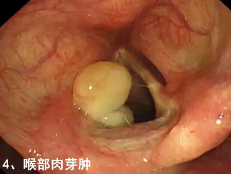 感冒后嗓子痒咳嗽怎么办_感冒咳嗽嗓子发痒咳嗽吃什么药_感冒后咳嗽嗓子痒吃什么药