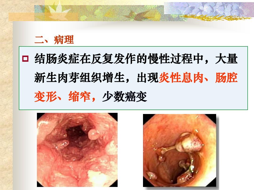 克罗恩病 木梳征图片_克罗恩病 木梳征图片_克罗恩病 木梳征图片
