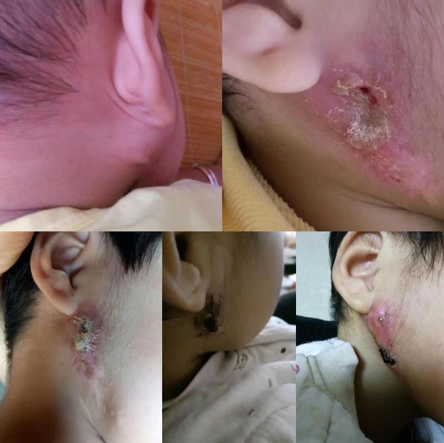 手术长流脓肛瘘时间多久_肛瘘手术 长时间流脓_肛瘘手术脓水要流多少天