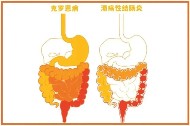 罗克罗恩病的特征性体征_课罗恩病_克罗恩病的六大标准