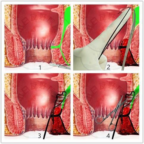 肛瘘手术伤口愈合时间_伤口愈合手术肛瘘时间多久_肛瘘手术伤口愈合标准