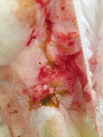 拉屎出鲜血能自愈吗_拉大便时只拉出鲜血_大便时拉出血来