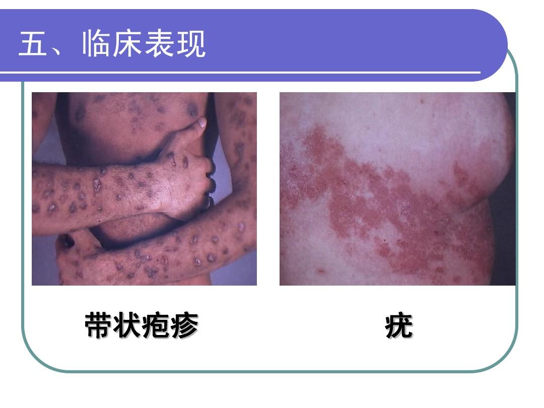罗克恩病严重吗_克罗恩病好发部位_罗克罗恩病