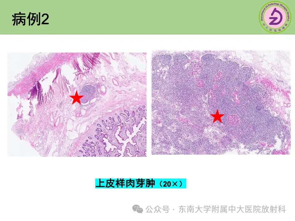 罗克罗恩病的特征性体征_克罗恩病诊断临床分型_罗克罗恩病