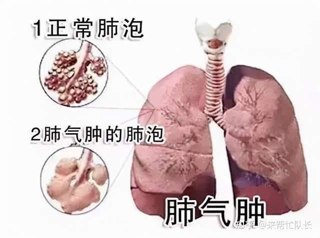 白肺病的症状是什么表现_白肺病_白肺病早期的症状有哪些