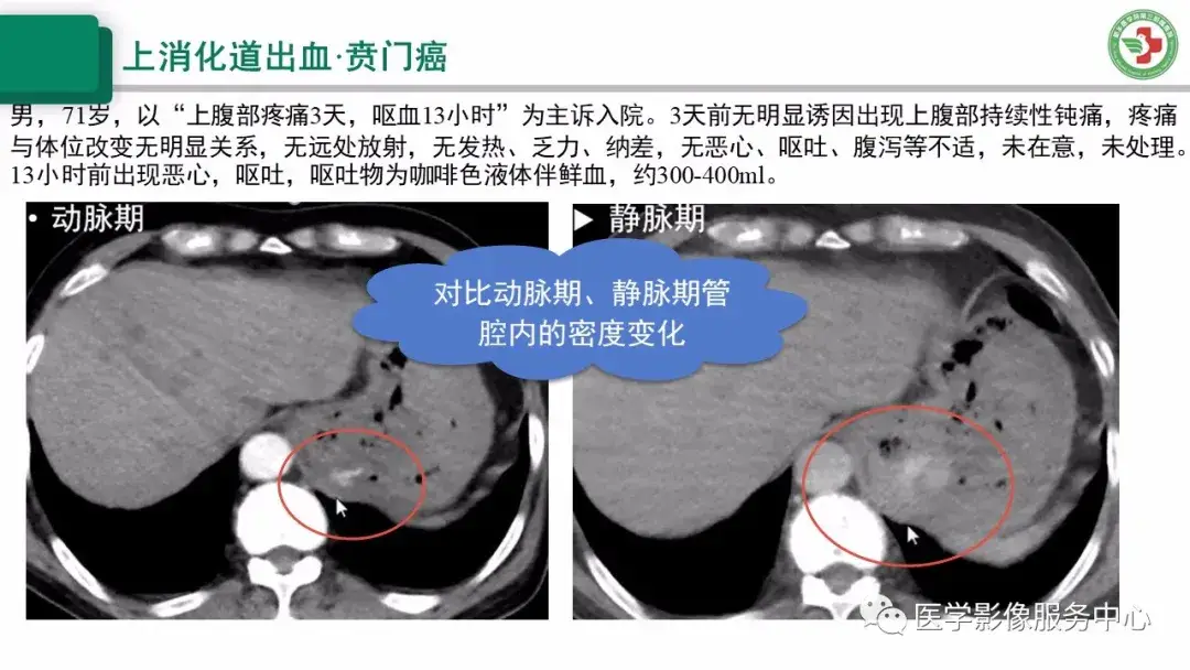 消化道穿孔ct图片_消化道穿孔典型ct图片_消化道穿孔的x线图片