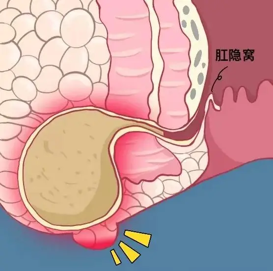 男友插肛门 大便失禁_大便失禁肛门袋_大便失禁肛门疼