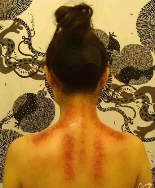 咳嗽后背疼是肺癌吗_咳嗽后背疼是肺癌症状的表现_咳嗽后背疼是肺都不好吗