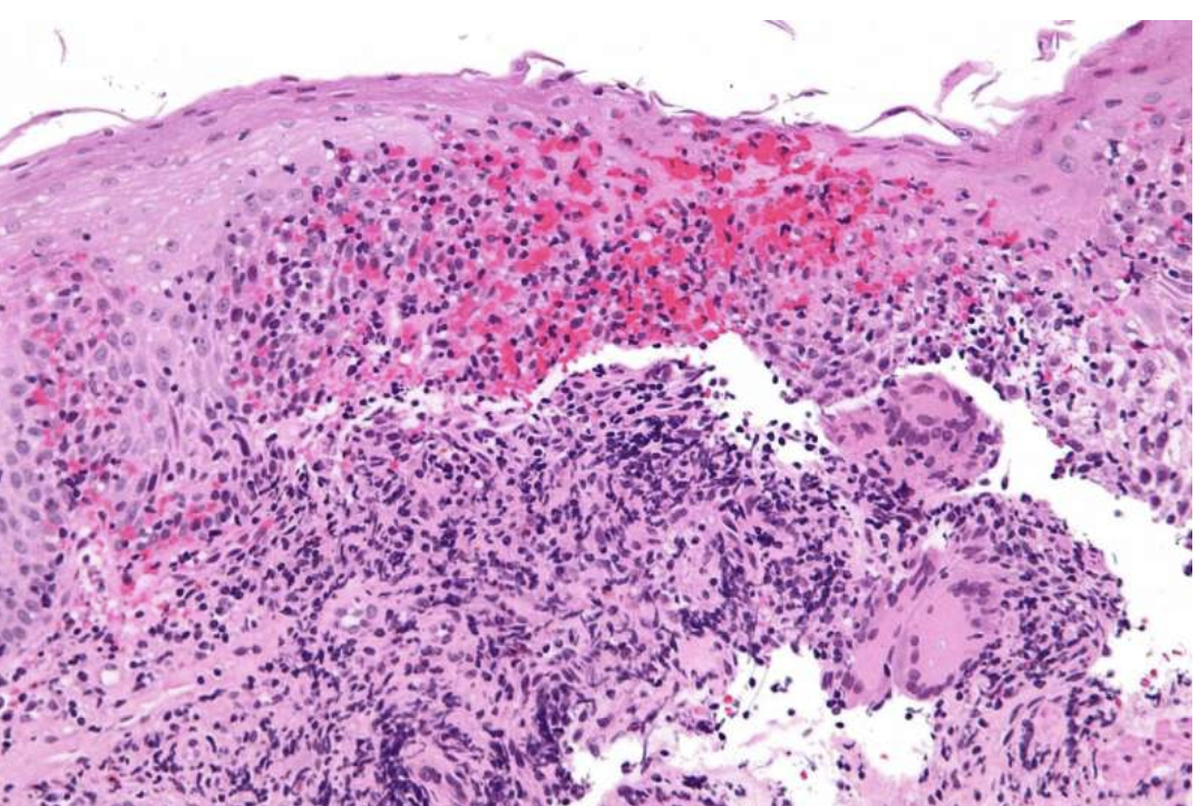 crohn病是什么医学意思_crohn_crohn病