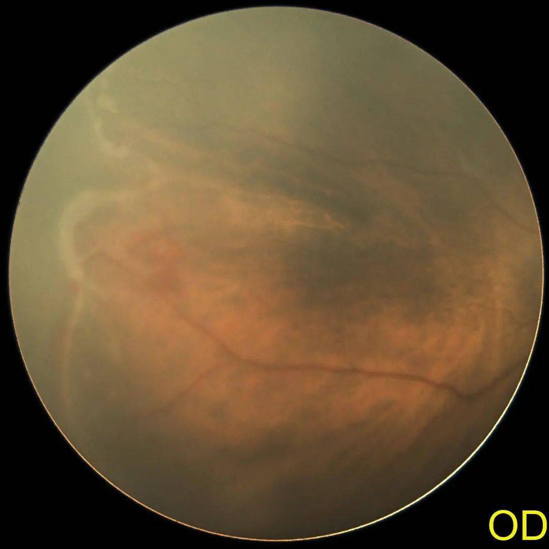 小婴儿白眼球发蓝_婴儿白眼珠子发蓝_婴儿白眼球发蓝怎么回事