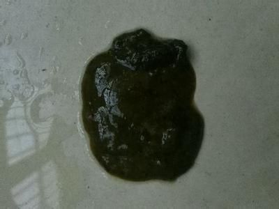 大便常规能查出克罗恩病吗_克罗恩病的大便图片_克罗恩大便形状