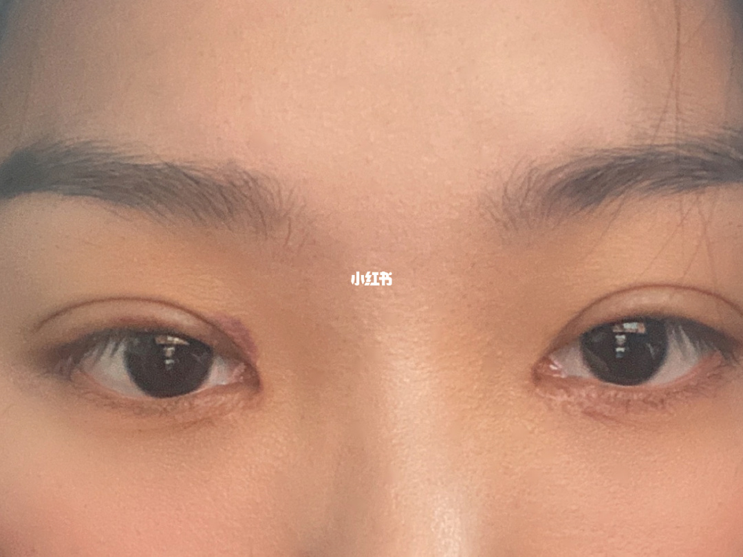 双眼皮拆线好天天拆吗_双眼皮拆线好天天换药吗_双眼皮几天拆线最好
